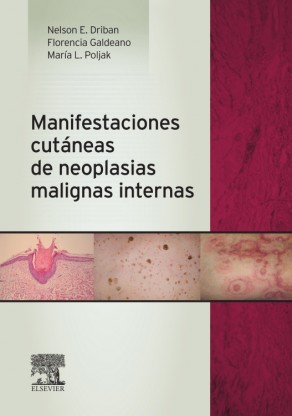 Seller image for Manifestaciones cutneas de neoplasias malignas internas for sale by Vuestros Libros