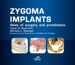 Imagen del vendedor de Zygoma Implants a la venta por Vuestros Libros