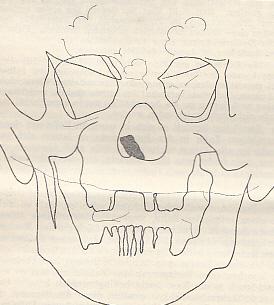 Seller image for Ein berzhliger Zahn in der Nase, zugleich ein Beitrag des hohen Gaumens. IN: Wiener klinische Wochenschrift, XVII/40, S. 1030-1033, 2 Fig., 1905, Br. for sale by Antiquariat Michael Eschmann