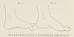 On Contraction of the Metatarso-phalangeal Joint of the Great toe (Hallux flexus). With Cases (pp...