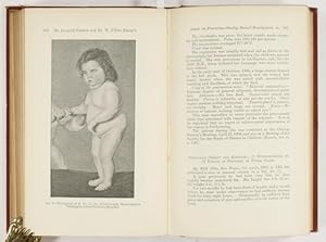 Bild des Verkufers fr Precocious Obesity, Premature Sexual and Physical Development and other Morbid Conditions (pp.175-202, 4 Fig., 2 plates with explanations leafs). zum Verkauf von Antiq. F.-D. Shn - Medicusbooks.Com