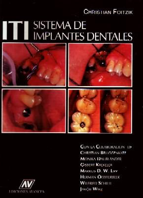 ITI SISTEMA DE IMPLANTES DENTALES.