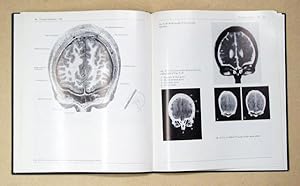 Bild des Verkufers fr Computed Tomography of the Brain. Atlas of Normal Anatomy. zum Verkauf von antiquariat peter petrej - Bibliopolium AG