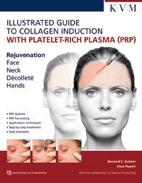 Seller image for Kolster/Paasch: Illustrated Guide to Collagen Induction with Platelet-Rich Plasma (PRP) for sale by Vuestros Libros
