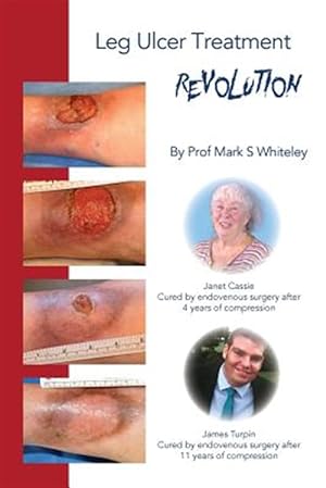 Bild des Verkufers fr Leg Ulcer Treatment Revolution zum Verkauf von GreatBookPrices