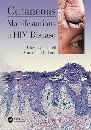 Imagen del vendedor de Cutaneous Manifestations of HIV Disease a la venta por GreatBookPrices