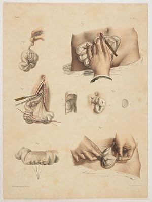 Bild des Verkufers fr Darmchirurgie. - 4 Tafeln nach Zeichnungen von N.H. Jacob. zum Verkauf von Antiq. F.-D. Shn - Medicusbooks.Com