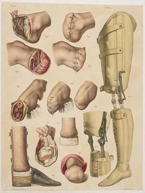 Bild des Verkufers fr Amputations du Pied et de la Jambe. 1 Tafel nach Zeichnungen von N.H.Jacob. zum Verkauf von Antiq. F.-D. Shn - Medicusbooks.Com