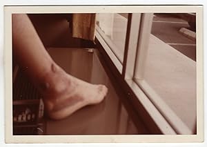 FOOT WOUND or BURN VINTAGE COLOR SNAPSHOT PHOTO