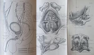 Ueber Harnröhrenkrampf. IN: Verh.dtsch.Ges. Chir., 1879, 8, S. 98-114, 1 aufklappbare lithogr. Ta...