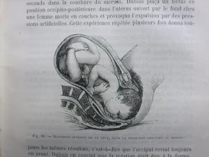 1883 Traite pratique de l'art des accouchements.