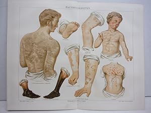 Meyers Antique Chromolithograph HAUTKRANKHEITEN (Skin Diseases) (1890)