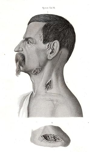 Bild des Verkufers fr Operative Tafel VI. Unterbindung der Arterien am Kopfe und Halse zum Verkauf von Antiquariat Kastanienhof