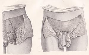 Bild des Verkufers fr Anatomische Tafel. Unterleibsbrche zum Verkauf von Antiquariat Kastanienhof