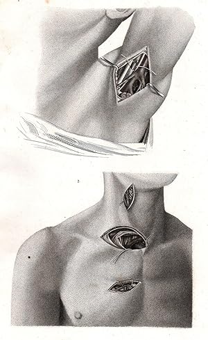 Bild des Verkufers fr Operative Tafel VII. Unterbindung der Arterien in der Achselhhle, am Halse und an der Brust zum Verkauf von Antiquariat Kastanienhof