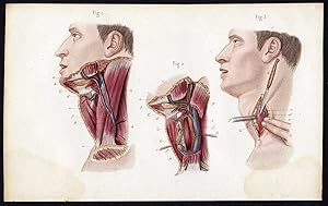 Antique Print-SURGERY-OPERATION-ESOPHAGUS-ESOPHAGOSTOMY-Bernard-Davesne-1846