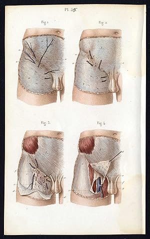 2 Antique Prints-SURGERY-OPERATION-HERNIA-GENITALS-ABDOMEN-Bernard-Davesne-1846