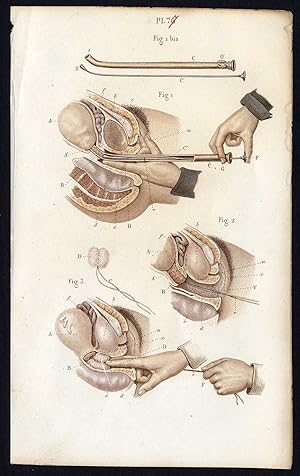 Antique Print-SURGERY-PREGNANCY-CHILDBIRTH-PRETERM-UTERUS-Bernard-Davesne-1846