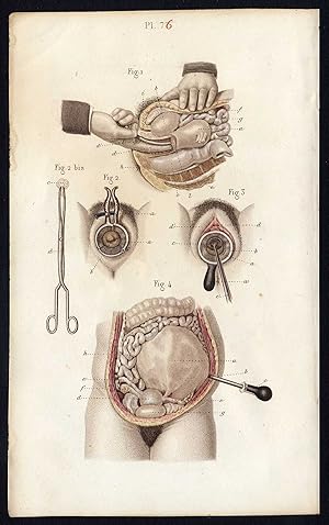 Antique Print-SURGERY-OPERATION-UTERUS-CERVIX-VAGINA-Bernard-Davesne-1846