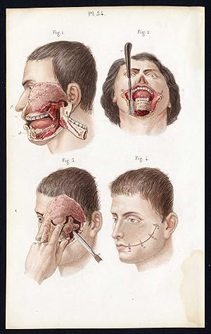 Antique Print-SURGERY-RESECTION-SEGMENTECTOMY-JAW-OPERATION-Bernard-Davesne-1846