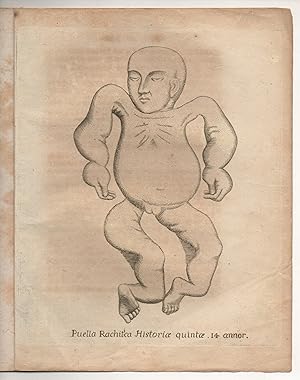 Bild des Verkufers fr Medizinische Inaugural-Dissertation. De rachitide perfecta et imperfecta. zum Verkauf von Wissenschaftliches Antiquariat Kln Dr. Sebastian Peters UG