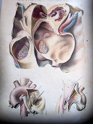 Anatomie pathologique du corps humain, ou descriptions, avec figures lithographiées et coloriées,...