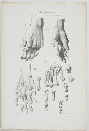 Malattie della Mano. - 2 Tafeln aus: Atlante Generale della Anatomia Pathologica des Corpo Umano.