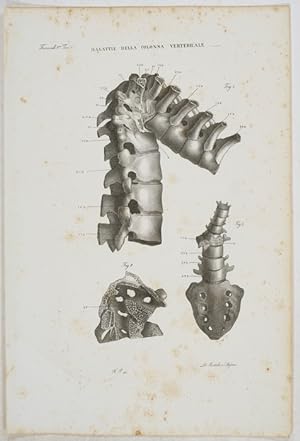 Malattie della Colonna Vertebrale. - Tafel aus: Atlante Generale della Anatomia Pathologica des C...