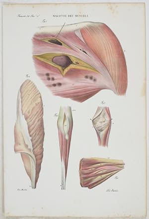 Malattie del Muscoli. - 1 Tafel aus: Atlante Generale della Anatomia Pathologica des Corpo Umano.