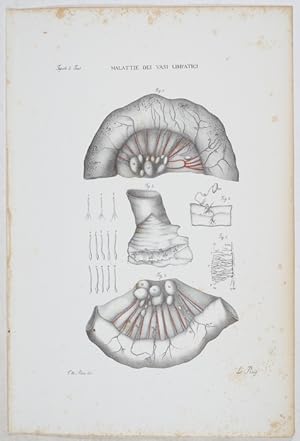 Malattie del Vasi Linfatici. - 1 Tafel aus: Atlante Generale della Anatomia Pathologica des Corpo...