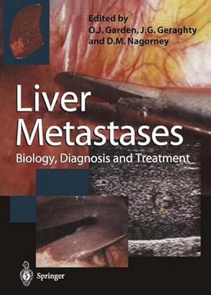 Bild des Verk�ufers f�r Liver Metastases : Biology, Diagnosis and Treatment zum Verkauf von AHA-BUCH GmbH