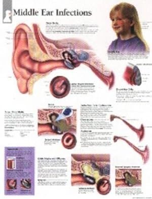 Seller image for Middle Ear Infections Paper Poster (Paperback) for sale by Grand Eagle Retail