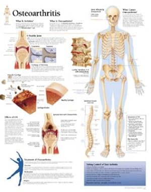 Imagen del vendedor de Osteoarthritis Paper Poster (Paperback) a la venta por Grand Eagle Retail