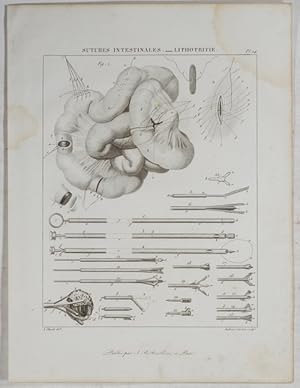 Bild des Verkufers fr Sutures Intestinales. - Lithotritie. A. Chazal del.; Ambroise Tardieu sculp. zum Verkauf von Antiq. F.-D. Shn - Medicusbooks.Com