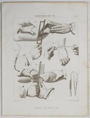 Resections des Os. A. Chazal del.; Ambroise Tardieu sculp.