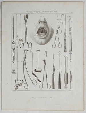 Staphyloraphie - Polypes du Nez. A. Chazal del.; Ambroise Tardieu sculp.