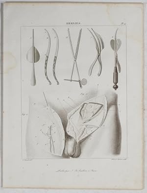 Hernies. A. Chazal del.; Ambroise Tardieu sculp.