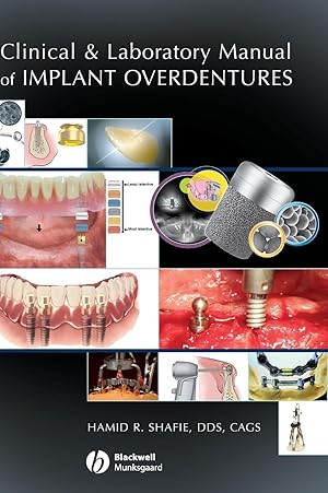 Bild des Verkufers fr Clinical and Laboratory Manual of Implant Overdentures zum Verkauf von moluna