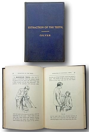 Image du vendeur pour EXTRACTION OF THE TEETH. mis en vente par John  L. Capes (Books) Established 1969