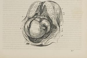 Bild des Verkufers fr Abortus und vom fibrinsen Uteruspolypen (pp.513-517, 1 Abb.). zum Verkauf von Antiq. F.-D. Shn - Medicusbooks.Com
