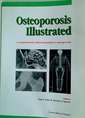 Bild des Verkufers fr Osteoporosis Illustrated. A Comprehensive Illustrated Guide to Osteoporosis. zum Verkauf von Plurabelle Books Ltd
