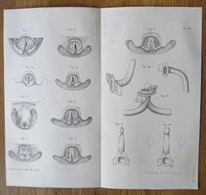 Bild des Verkufers fr Die Laryngo- und Tracheostenosen im Verlaufe des Abdominaltyphus und ihre chirurgische Behandlung. Lithographie von Albin Schtze, Berlin, mit 12 fig. Darstellungen aus Langenbeck's Archiv, ca. 23 x 25 cm, 1884. zum Verkauf von Antiquariat Michael Eschmann