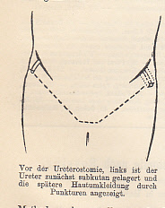 Zur lumbalen Ureterostomie nach Rovsing. IN: Zentralblatt für Chirurgie, 34/30, S. 873-875, 1 Ill...