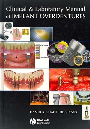 Image du vendeur pour Clinical and Laboratory Manual of Implant Overdentures mis en vente par GreatBookPricesUK