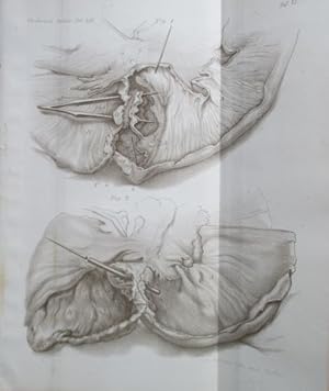 Invagination/Intussuszeption des Darms. Lithographie von A. Schütze, 21,0 x 17,5 cm, aus: Virchow...