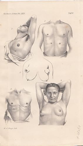 Brustwarzen. Bildliche Darstellung von supernumerären (accessorischer) Brüste und Brustwarzen. Li...