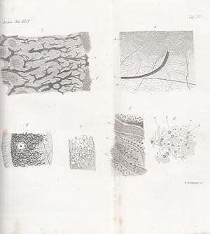 Ueber interstitielle Encephalitis. IN: Virchows Arch. path. Anat., 44, S. 472-476, 1 lithografisc...