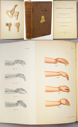 Bild des Verkufers fr ON FRACTURES AND DISLOCATIONS. Translated from the Third Edition (1897) With Notes and Additional Illustrations by J. Hutchinson. zum Verkauf von Francis Edwards ABA ILAB