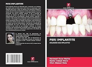 Seller image for PERI IMPLANTITE for sale by moluna