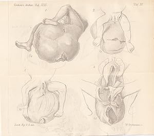 Angeborene Geschwülste in der Gegend des Kreuzbeins. Lithographie von Albert Schütze, 18 x 21,5 c...